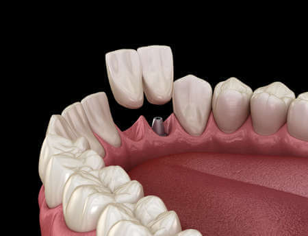 Cantilever dental bridge