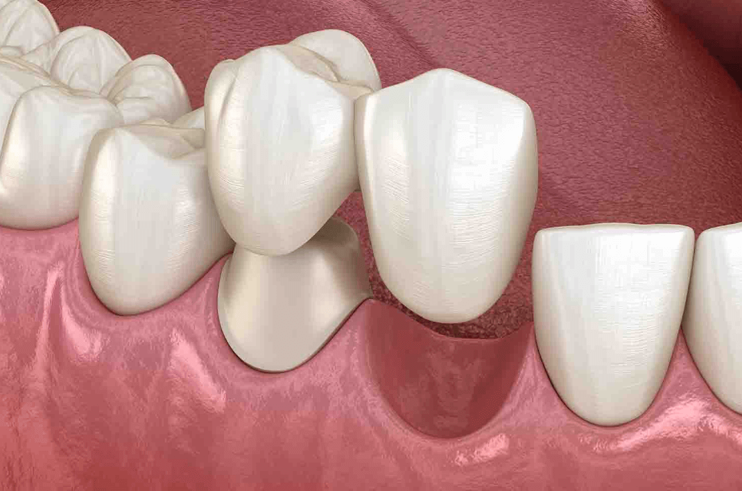 Cantilever Dental Bridge - Downtown Toronto Dentist