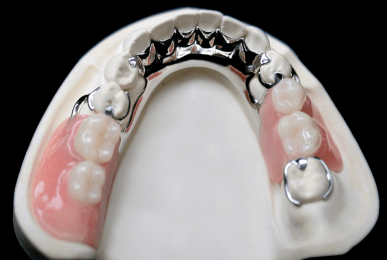 Cast partial denture