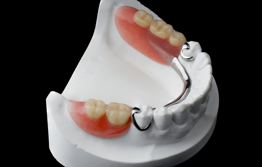 Cast Partial Denture - Atlas Dental Toronto