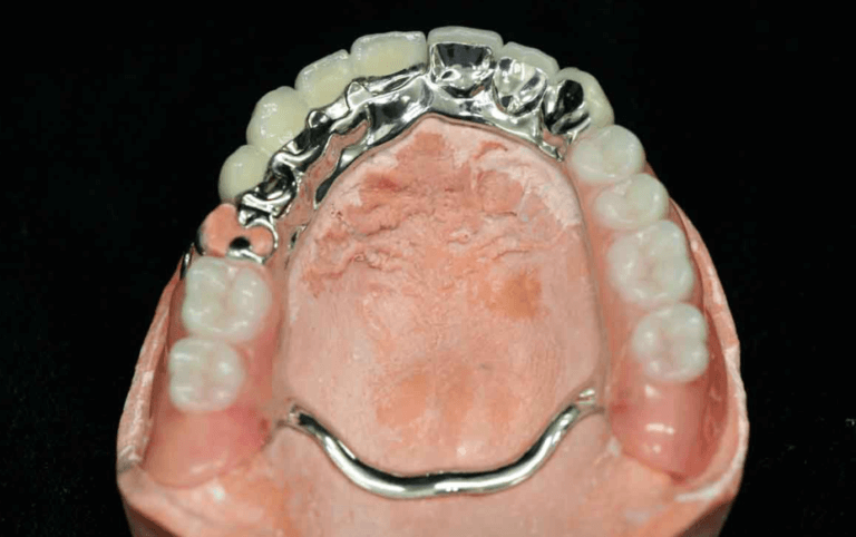 Cast partial denture