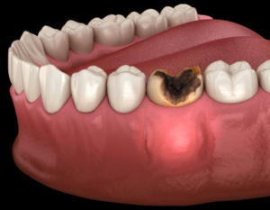 Dental abscess