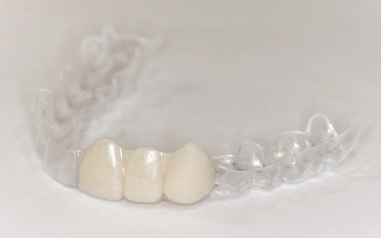 Essix denture