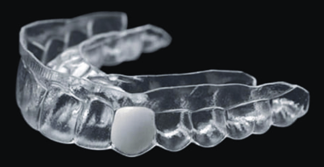 Essix denture