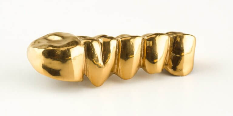 Gold dental bridge