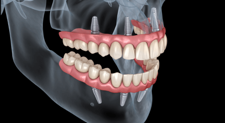 implant denture