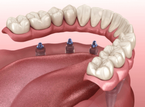 implant denture