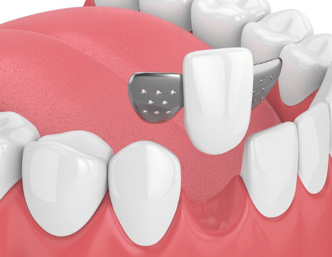 Maryland dental bridge