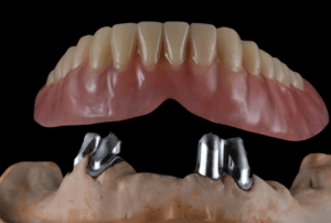 overdenture