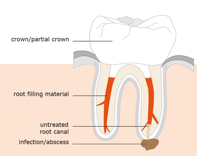 root canal retreatment