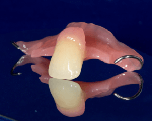 Single tooth partial denture