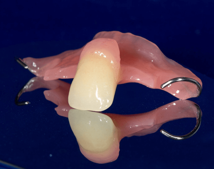 1 Tooth Partial Denture: The Ultimate Solution to a Missing Tooth