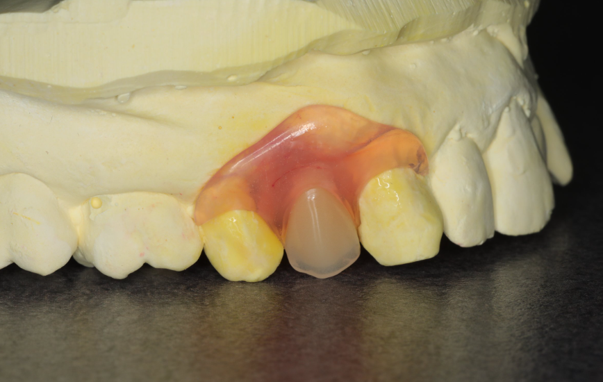 Single tooth partial denture