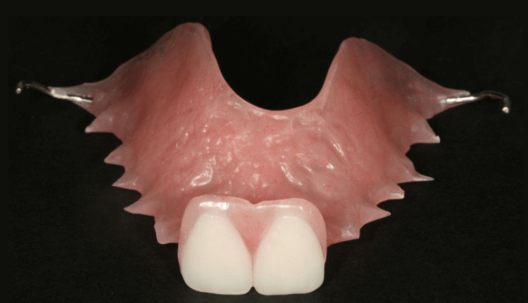 Single tooth partial denture