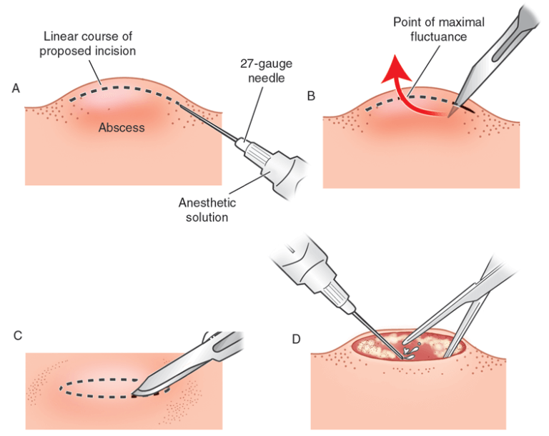 Steps in abscess drainage procedure