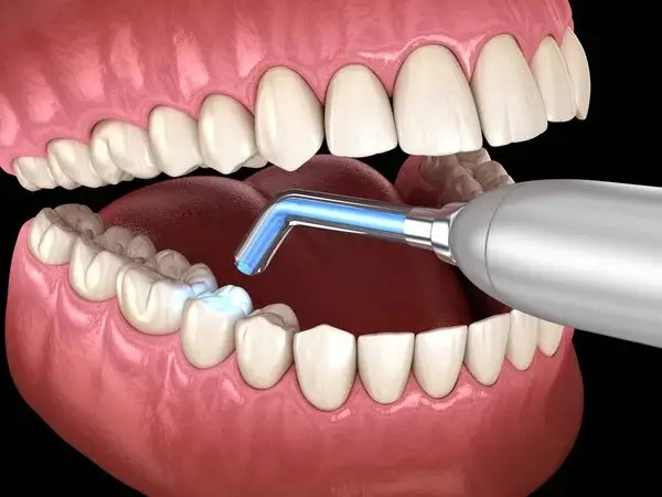 composite resin and glass ionomer filling