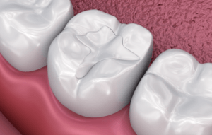 composite resin and glass ionomer filling