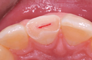 dental pulp capping