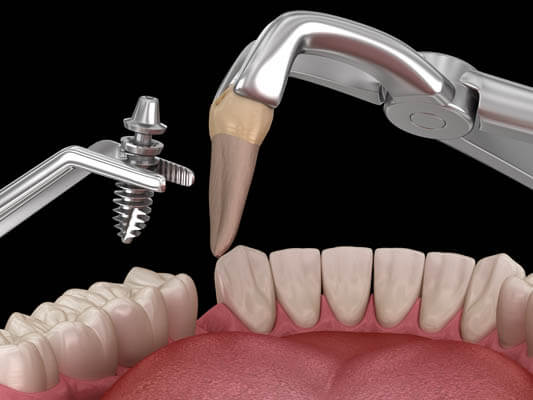 Immediate dental implant placement