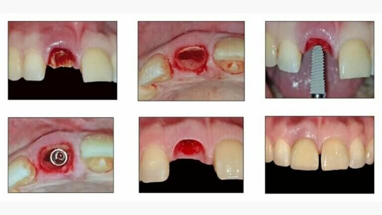 Immediate dental implant placement steps of the procedure