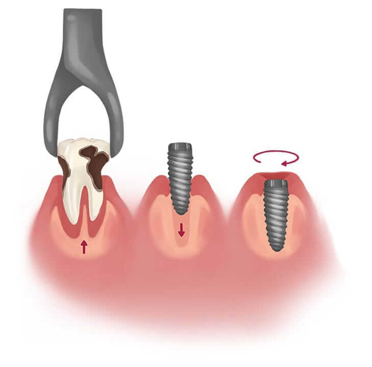 Immediate dental implant placement steps of the procedure