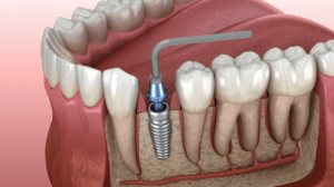 Immediate dental implant placement