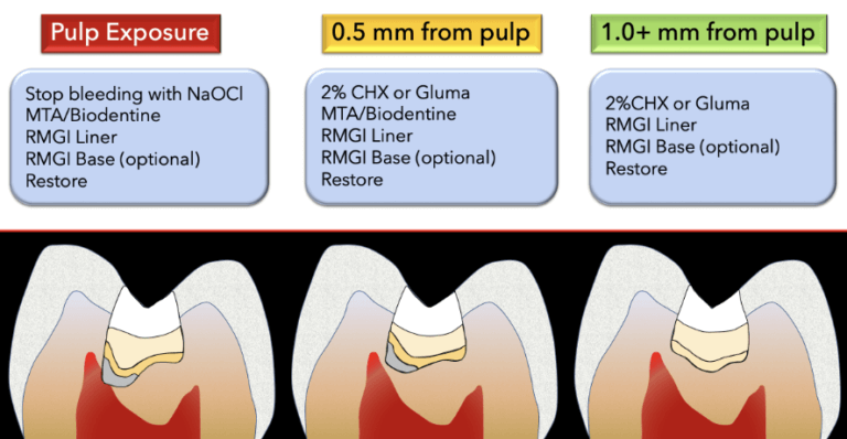 Pulp capping techniques