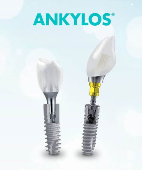 Ankylos dental implant