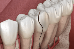 Cracked tooth syndrome