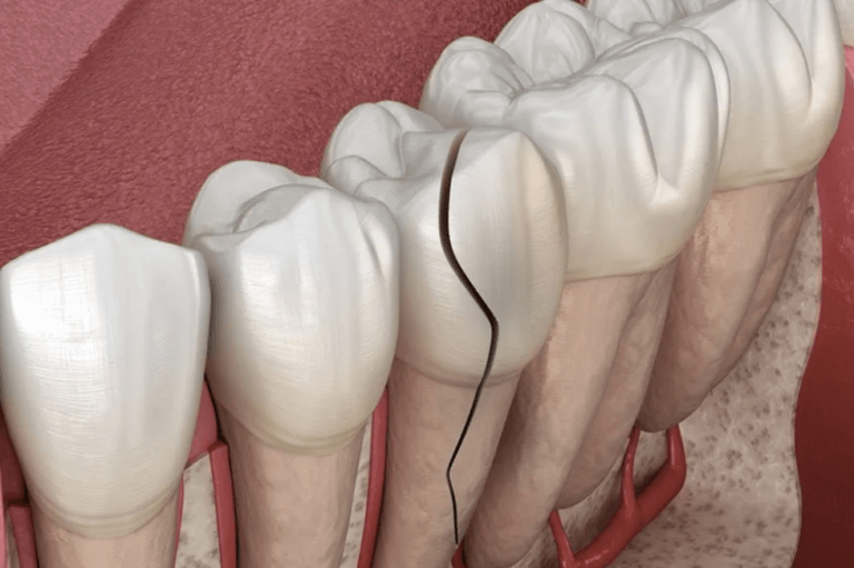 Cracked tooth syndrome