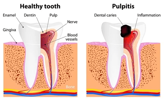 Pulpitis