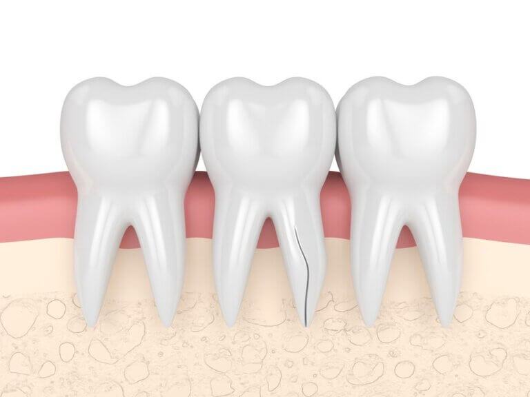 Vertical root fracture