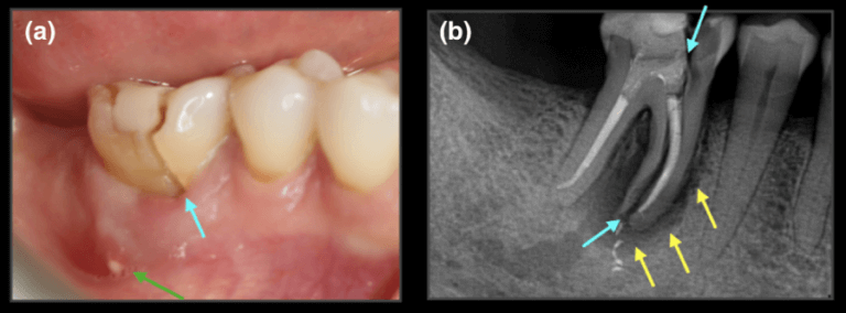 Vertical root fracture