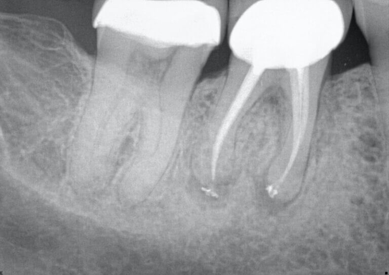 Vertical root fracture