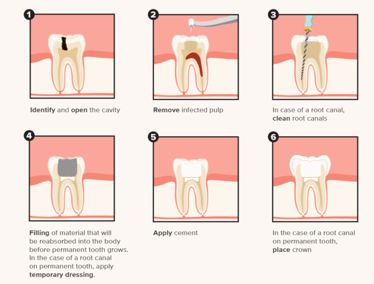 Pulpectomy procedure