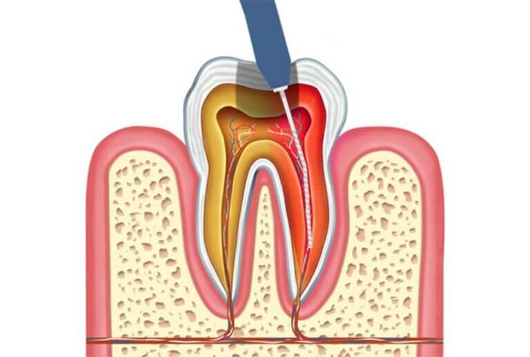 Pulpectomy