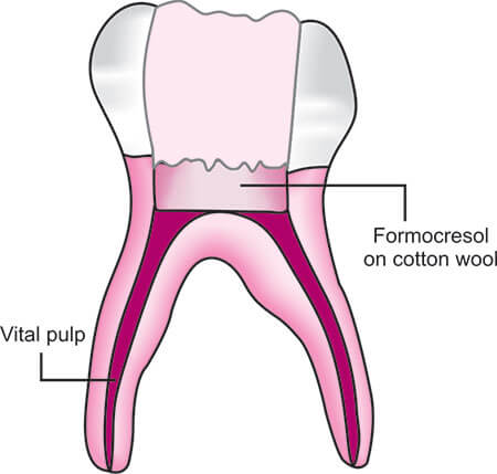 Pulpotomy