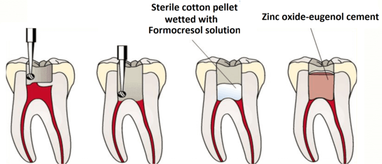 Pulpotomy procedure