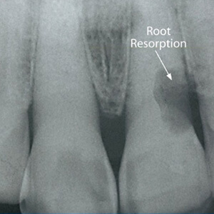 External root resorption