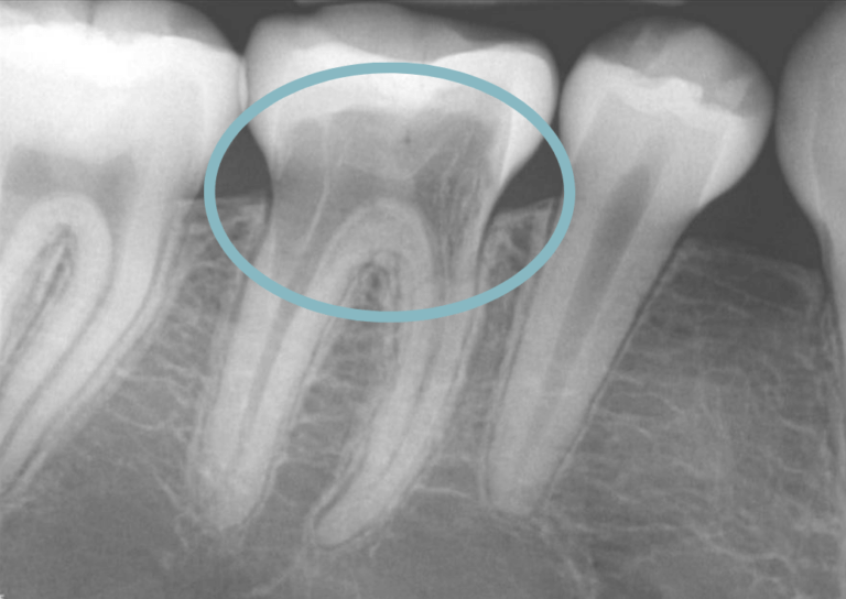 External root resorption