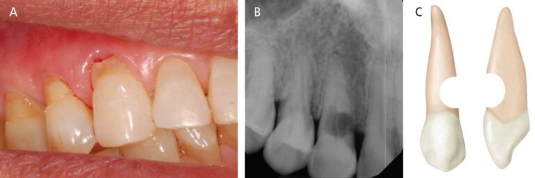 External root resorption