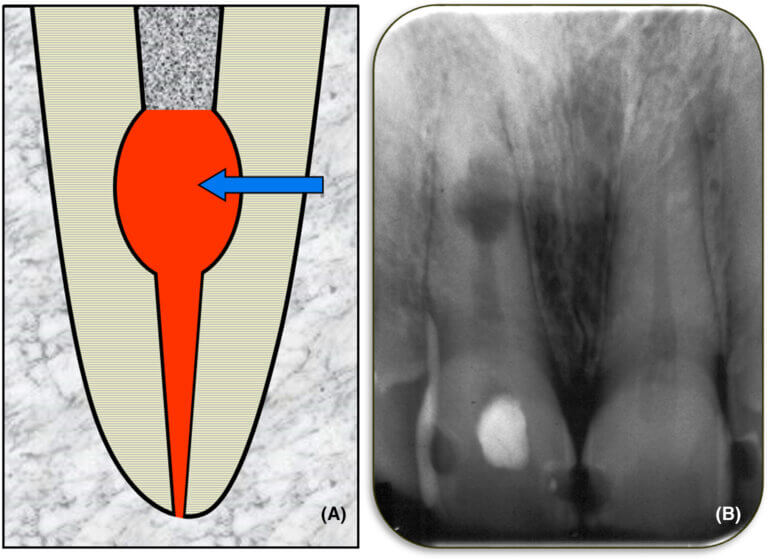 Internal root resorption