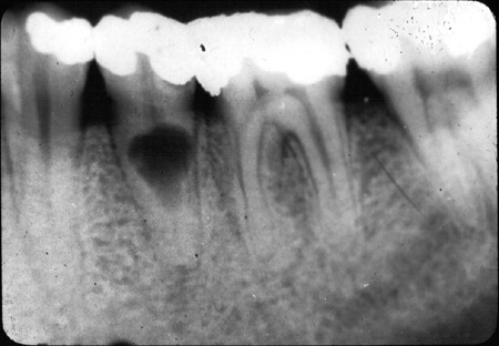 Internal root resorption