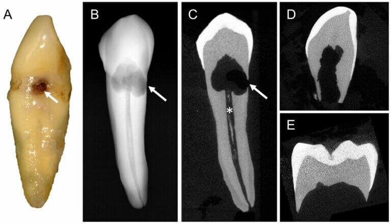 Internal root resorption