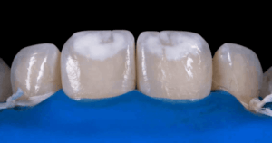 Dental white spot lesions