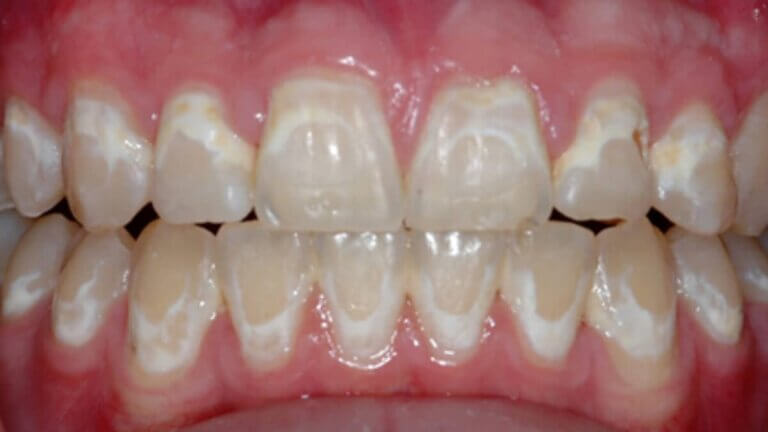 Dental white spot lesions