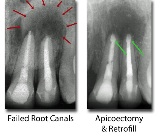 Apicoectomy xray