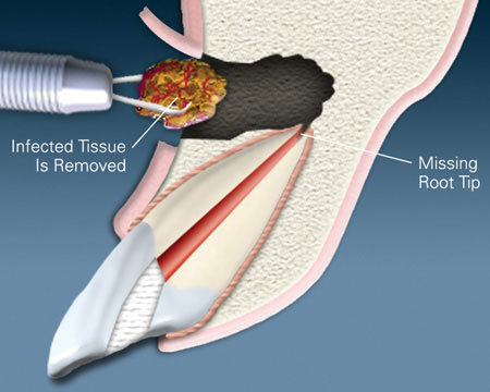 Apicoectomy surgery