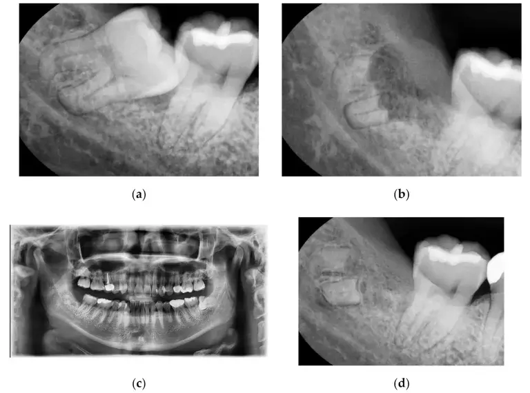 Coronectomy surgery xray