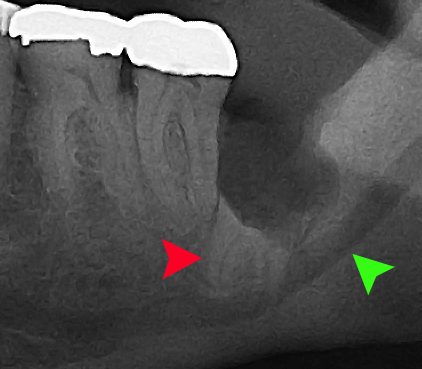 Coronectomy xray